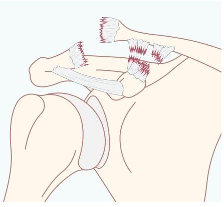 Luxação Acromioclavicular - 400