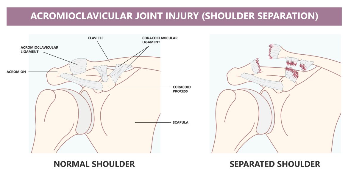 Luxação Acromioclavicular