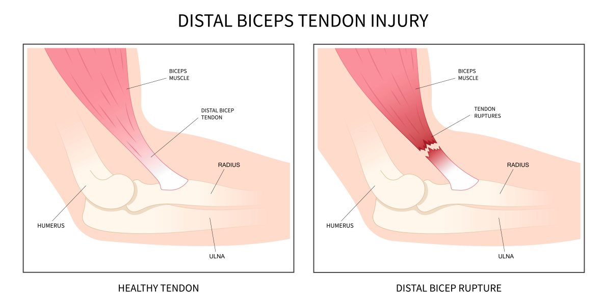 Ruptura do Bíceps Distal 1200
